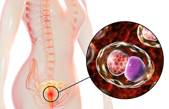 3D-illustrasjonen viser en kvinne med nærbilde av bakterien chlamydia trachomatis, som har infisert cellene i livmorhalsen