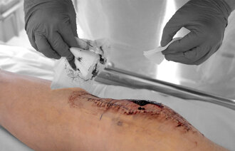 Bildet viser stelling av sår.