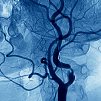 Bildet viser et angiogram av en innsnevret arterie i nakken.