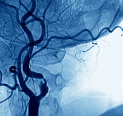 Bildet viser et angiogram av en innsnevret arterie i nakken.
